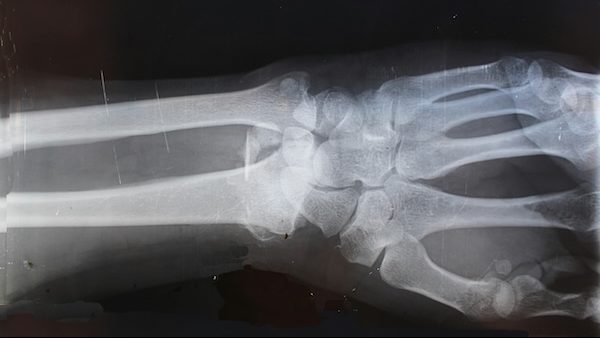 x-ray of acl injury